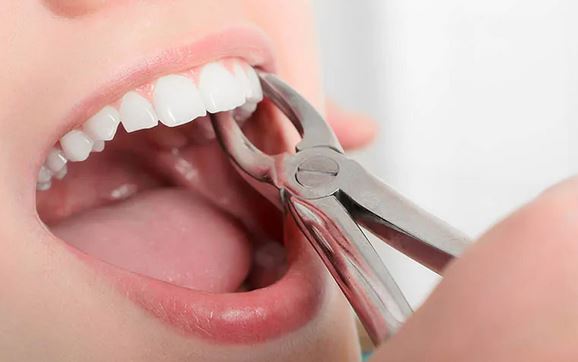 عصب‌کشی دندان با قیمت شفاف | درمان تخصصی درد و عفونت ریشه