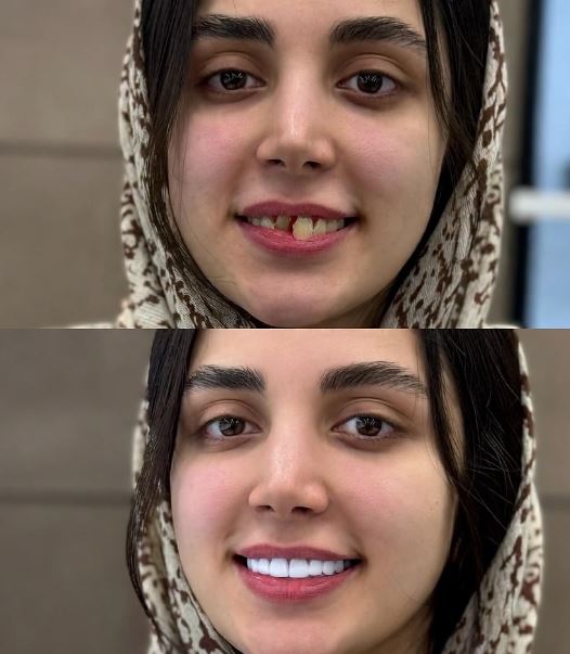 کامپوزیت ونیر دندان چیست؟ + مزایا و فرآیند انجام