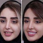 کامپوزیت ونیر دندان چیست؟ + مزایا و فرآیند انجام