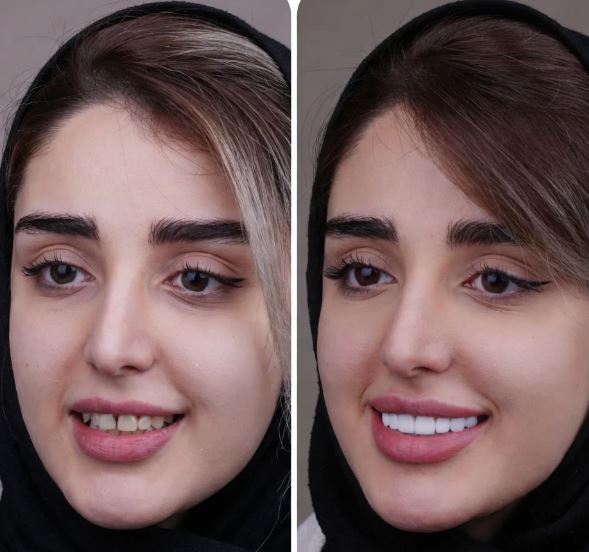 کامپوزیت ونیر دندان چیست؟ + مزایا و فرآیند انجام