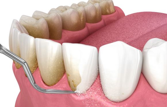 جرم‌گیری تخصصی دندان | پاکسازی عمیق، تنفس تازه