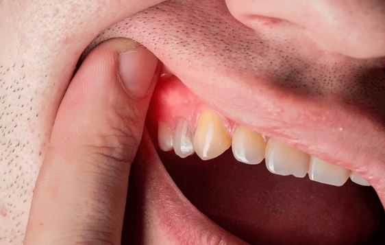 بیماری‌های لثه | علائم، درمان تخصصی + حفظ سلامت