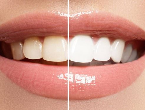 بلیچینگ دندان | سفید کردن حرفه‌ای با قیمت مناسب و ماندگاری بالا