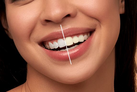 بلیچینگ دندان | سفید کردن حرفه‌ای با قیمت مناسب و ماندگاری بالا