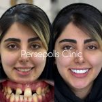 ایمپلنت دندان چیست؟ + مزایا و انواع آن