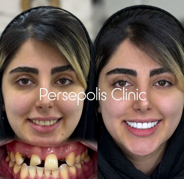 ایمپلنت دندان چیست؟ + مزایا و انواع آن