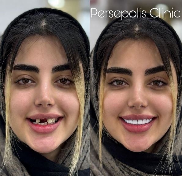 ایمپلنت دندان چیست؟ + مزایا و انواع آن