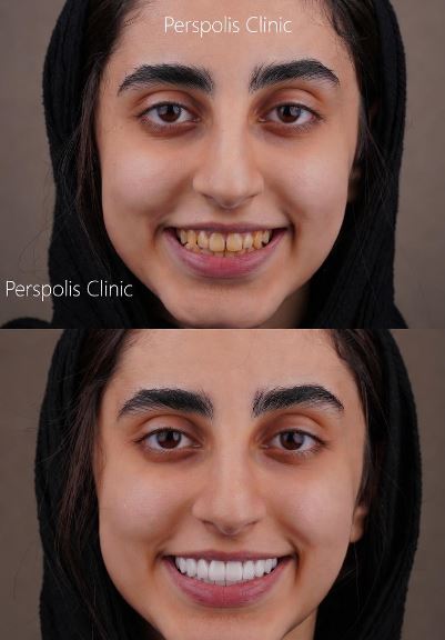 لمینت دندان چیست؟