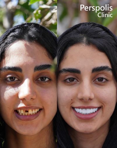 لمینت دندان چیست؟