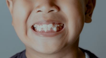 دندان اضافه | علل، عوارض و روش‌های درمان هایپردونشیا