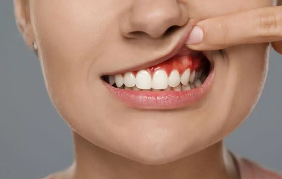 دلایل تحلیل لثه + عوارض و درمان آن