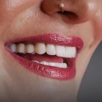 ایمپلنت سوئیسی