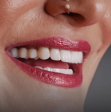 ایمپلنت سوئیسی