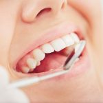 گیر غذایی دندان