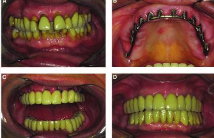 دندان فک‌جوش | علل، عوارض و روش‌های درمان آنکیلوز دندان
