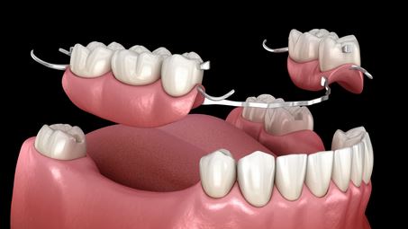 پروتز متحرک دندان | انواع، مزایا و مراقبت‌های ضروری