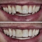 لب‌پر شدن دندان | دلایل، درمان سریع، حفظ زیبایی لبخند