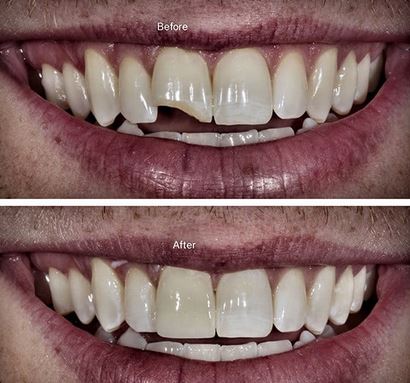 لب‌پر شدن دندان | دلایل، درمان سریع، حفظ زیبایی لبخند