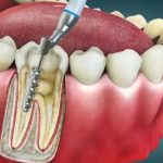 درمان ریشه دندان | حذف عفونت، حفظ دندان، قیمت مناسب