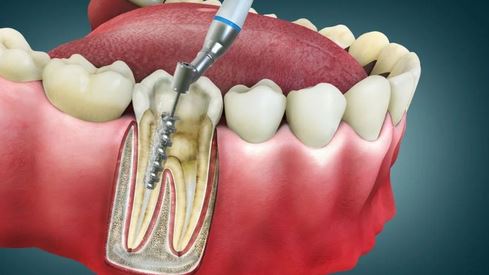 درمان ریشه دندان | حذف عفونت، حفظ دندان، قیمت مناسب