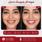 بلیچینگ دندان در تهرانپارس