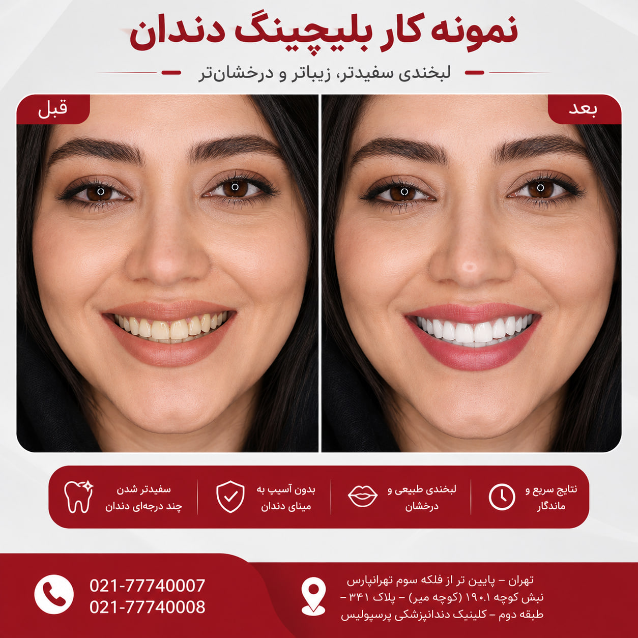 نمونه کار قبل و بعد بلیچینگ دندان