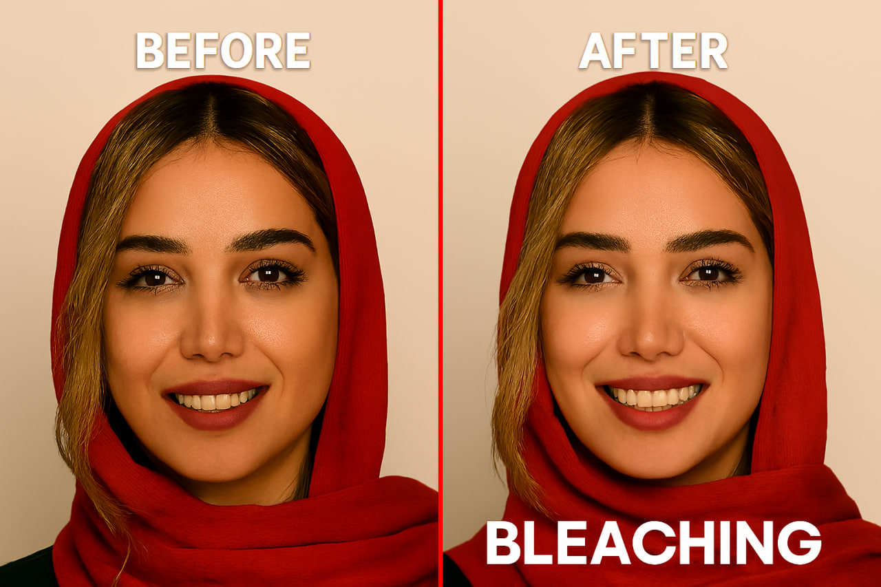 نمونه کار قبل و بعد بلیچینگ دندان