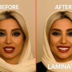 لمینت دندان