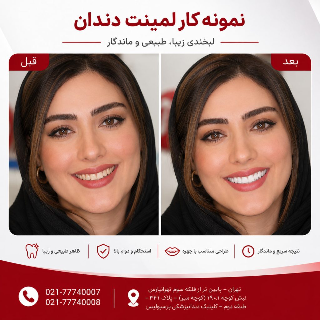 نمونه کار قبل و بعد لمینت دندان