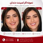 لمینت دندان در تهرانپارس
