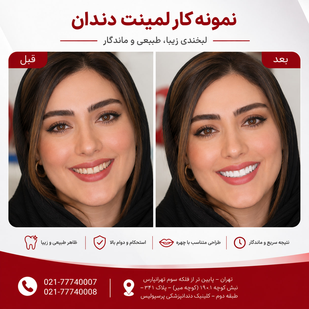 نمونه کار قبل و بعد لمینت دندان