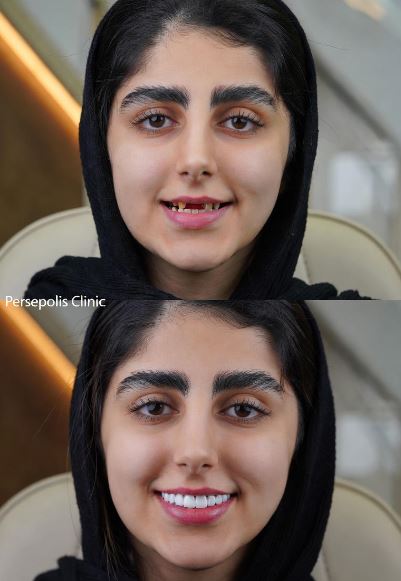 نمونه کار قبل و بعد لمینت دندان نمونه کار قبل و بعد لمینت دندان