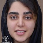 لمینت دندان در فلکه سوم تهرانپارس