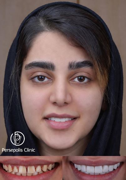 لمینت دندان در فلکه سوم تهرانپارس لمینت دندان در فلکه سوم تهرانپارس