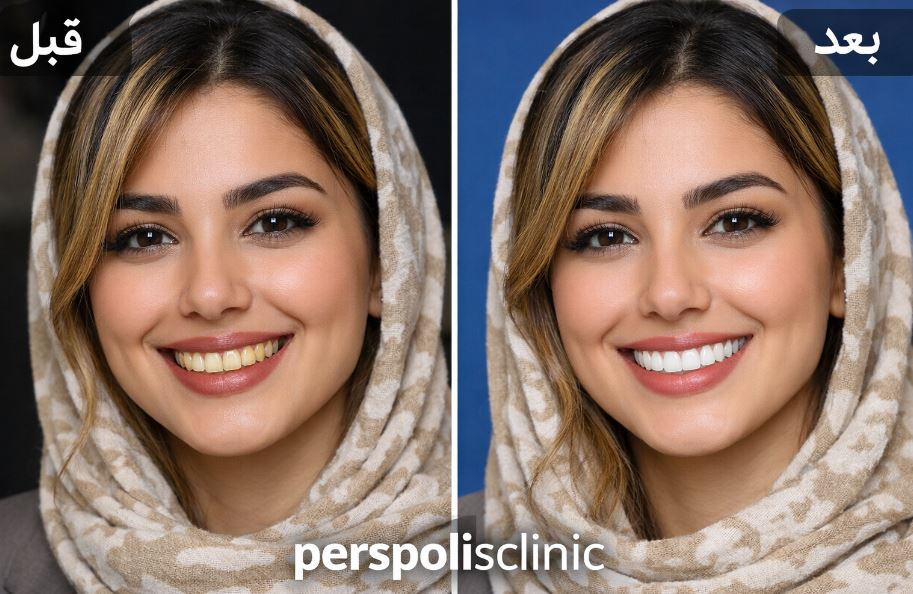 بلیچینگ دندان در فلکه سوم تهرانپارس بلیچینگ دندان در فلکه سوم تهرانپارس