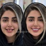 کامپوزیت دندان در فلکه سوم تهرانپارس