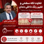 تفاوت لکه سطحی و تغییر رنگ داخلی دندان