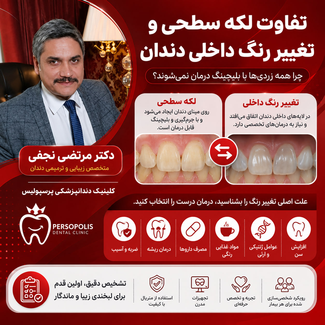 تفاوت لکه سطحی و تغییر رنگ داخلی دندان تفاوت لکه سطحی و تغییر رنگ داخلی دندان