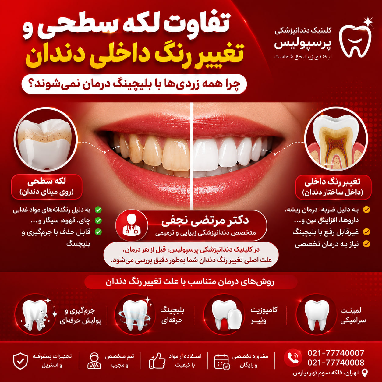 تفاوت لکه سطحی و تغییر رنگ داخلی دندان تفاوت لکه سطحی و تغییر رنگ داخلی دندان