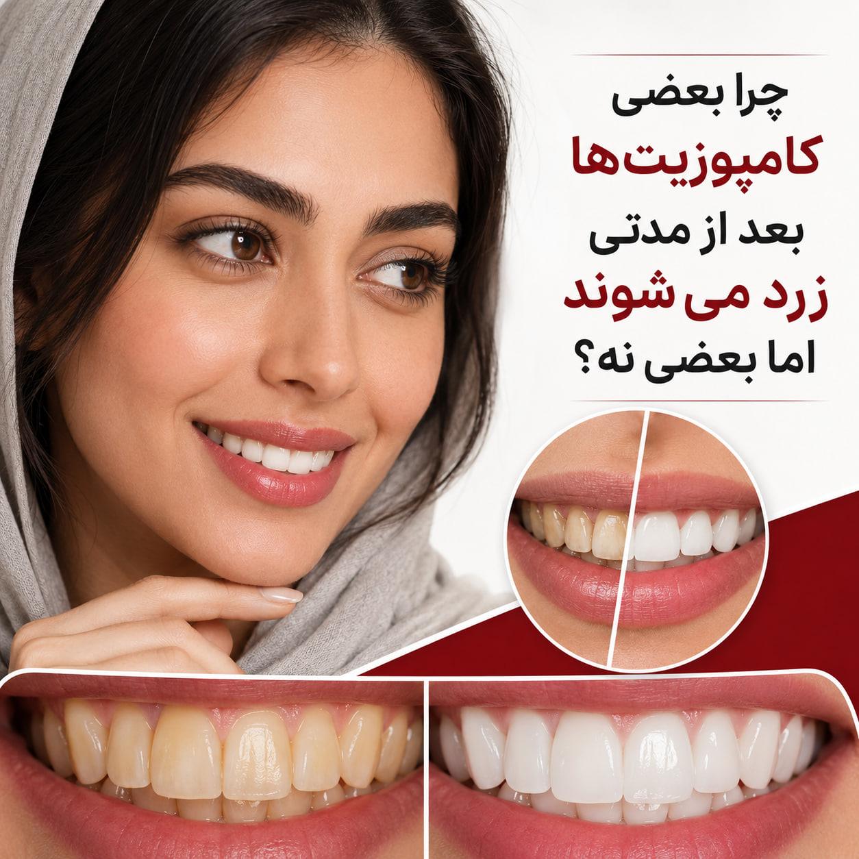 چرا بعضی کامپوزیت‌ها بعد از مدتی زرد می‌شوند اما بعضی نه؟